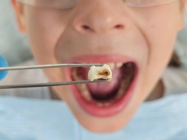 Best Broken or Chipped Tooth Repair in Gloverville, SC